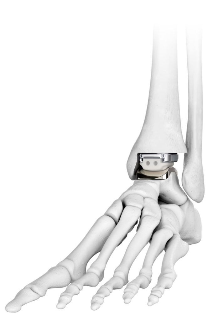 Rendering of restor3d’s Kinos Axiom Total Ankle System, a sandwiched assembly of shiny grey metal and white plastic with a curved bottom piece. It sits integrated into a rendering of a skeleton of the foot, replacing the ankle joint.