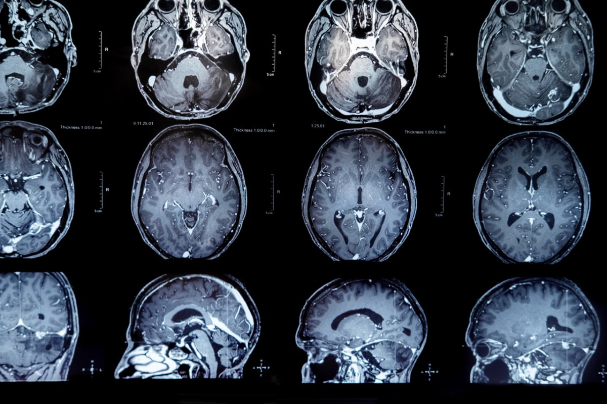 New therapy for glioma receives FDA approval, leveraging cancer ...